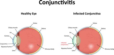 What Is Conjunctivitis